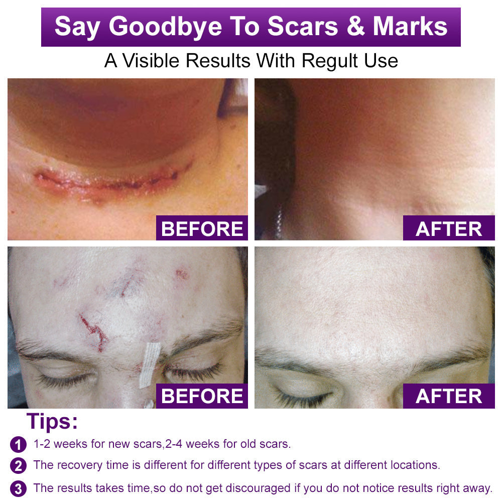 💙💙UKCA-CERTIFIED ✅RINGMIZ cure FACE & BODY SCAR GEL – Clinically proven to soften, flatten and fade surgical scars, acne marks, burns, keloids and trauma-related scars.