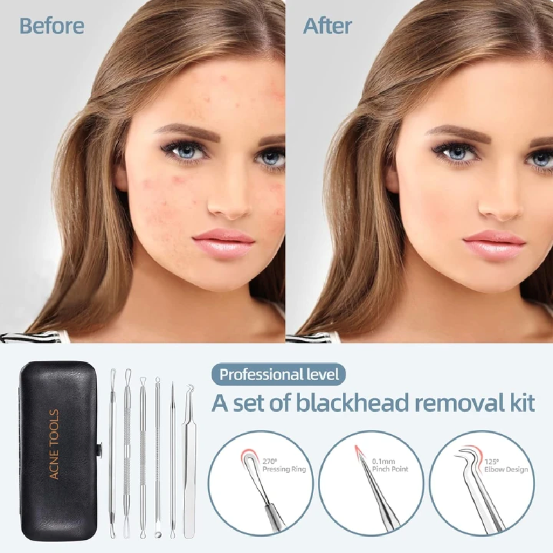 🌸Up to 40% OFF🔥6-piece blackhead remover set
