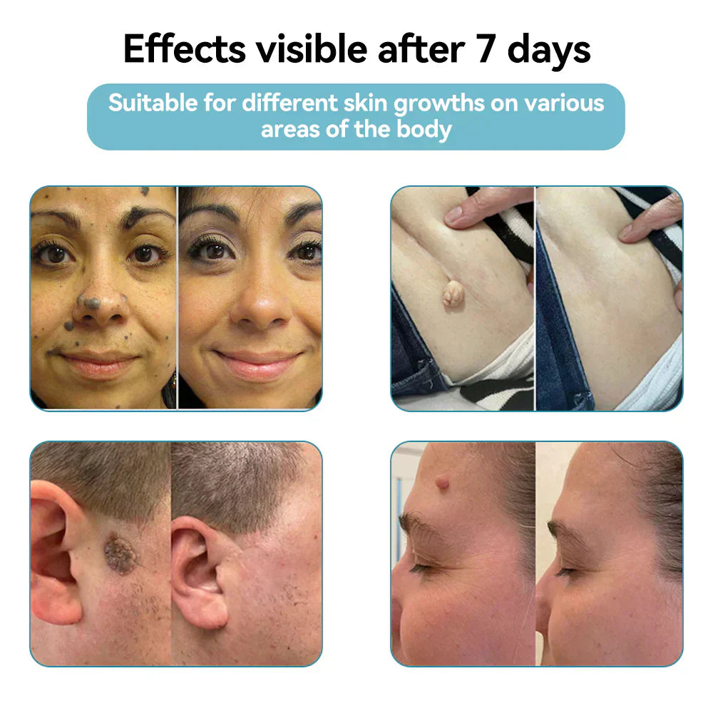 ✨Ringmiz All-in-One CO₂ Laser Eraser Pen | Removes Moles, Warts, Skin Flaws & Pigmentation
