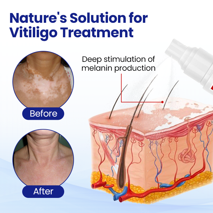 Vitiligo Treatment Spray