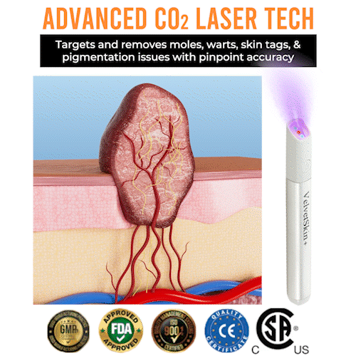 ✨Ringmiz All-in-One CO₂ Laser Eraser Pen | Removes Moles, Warts, Skin Flaws & Pigmentation