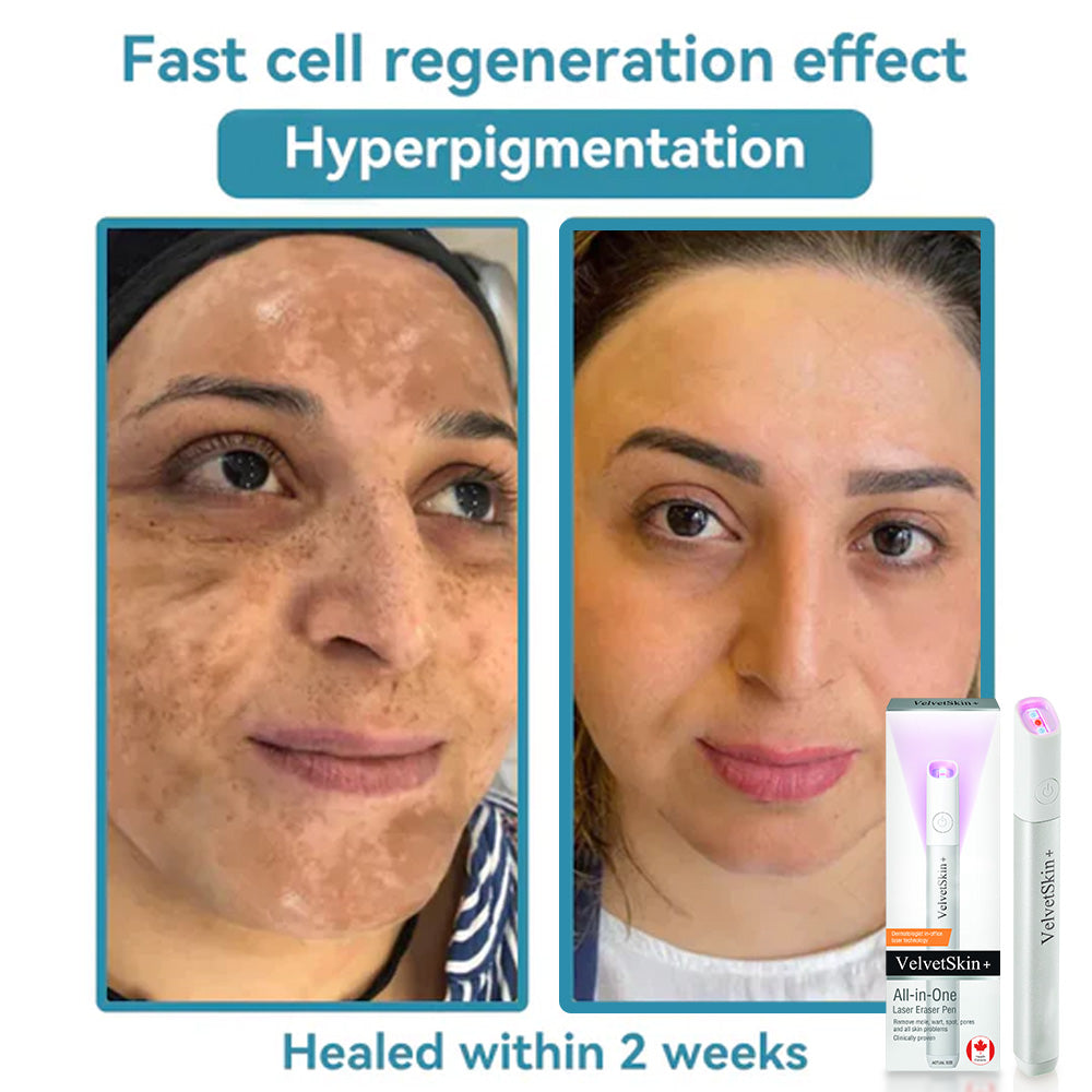 ✨Ringmiz All-in-One CO₂ Laser Eraser Pen | Removes Moles, Warts, Skin Flaws & Pigmentation
