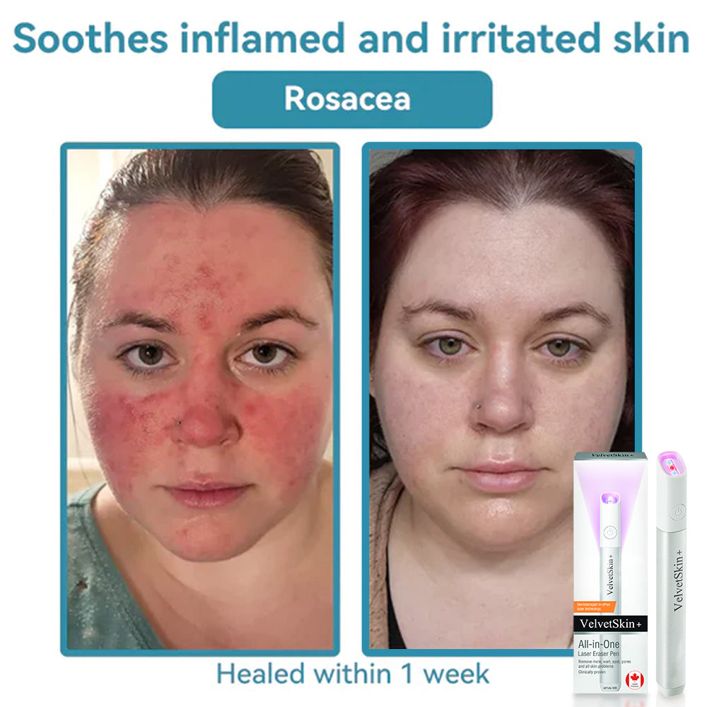 ✨Ringmiz All-in-One CO₂ Laser Eraser Pen | Removes Moles, Warts, Skin Flaws & Pigmentation