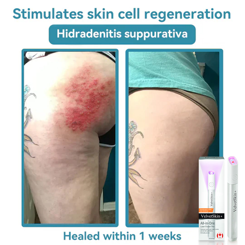 ✨Ringmiz All-in-One CO₂ Laser Eraser Pen | Removes Moles, Warts, Skin Flaws & Pigmentation