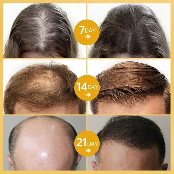 Rosemary Hair Growth Essence 100% Natural Hair Growth🌱