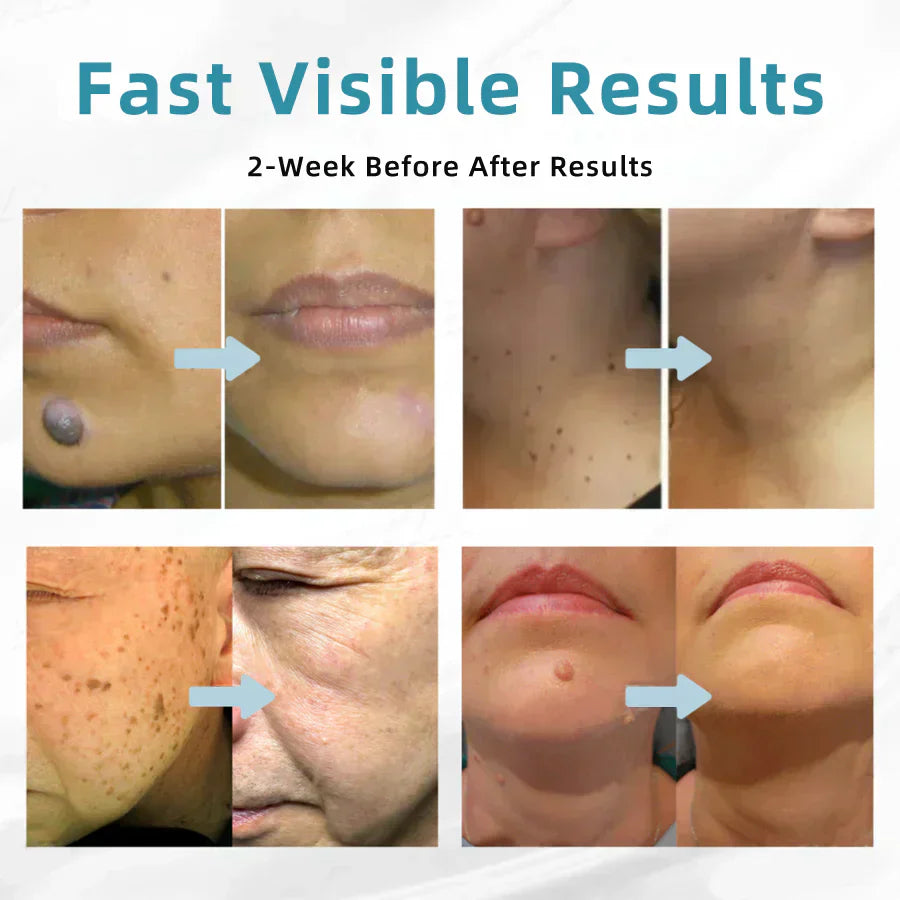 ✨Ringmiz All-in-One CO₂ Laser Eraser Pen | Removes Moles, Warts, Skin Flaws & Pigmentation