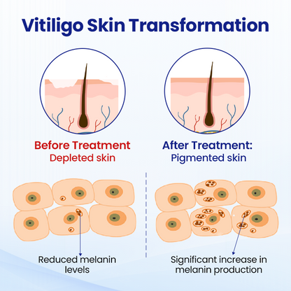Vitiligo Treatment Spray