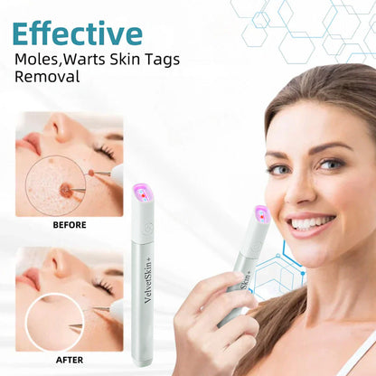 ✨Ringmiz All-in-One CO₂ Laser Eraser Pen | Removes Moles, Warts, Skin Flaws & Pigmentation